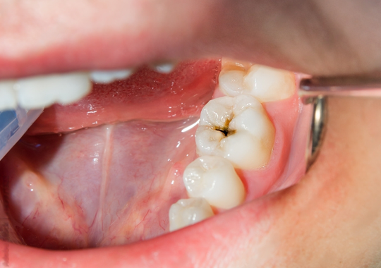 Tratamentos para a cárie: tudo o que você precisa saber - CVDentus