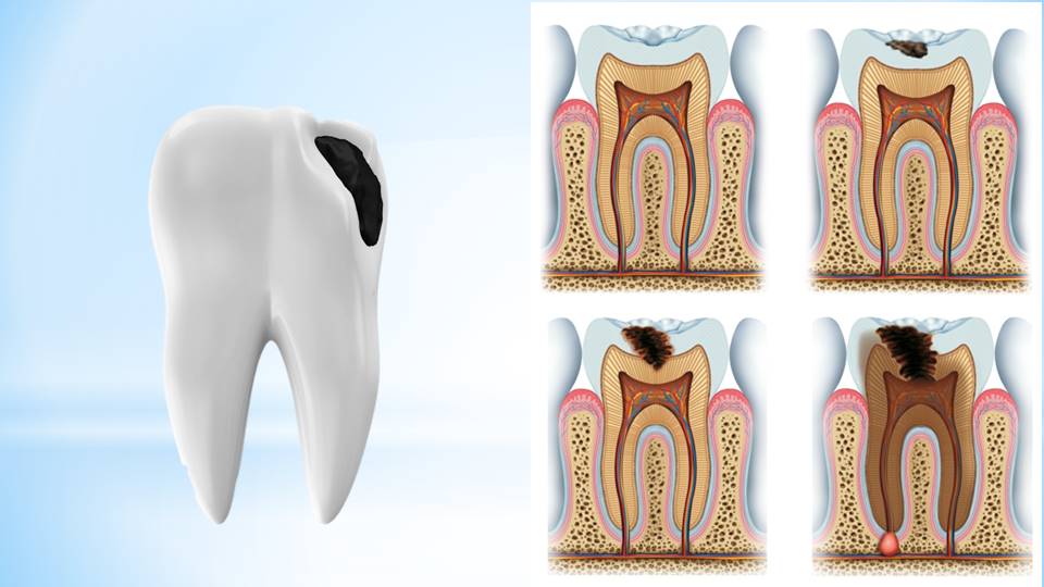 Orofacial #34 – Cárie Dentária – Orofacial