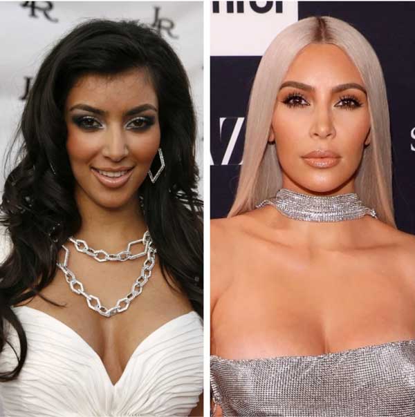 Cirurgias Plásticas da Kim Kardashian | Antes e depois da Kim Kardashian –  Dr. Érico Brasil