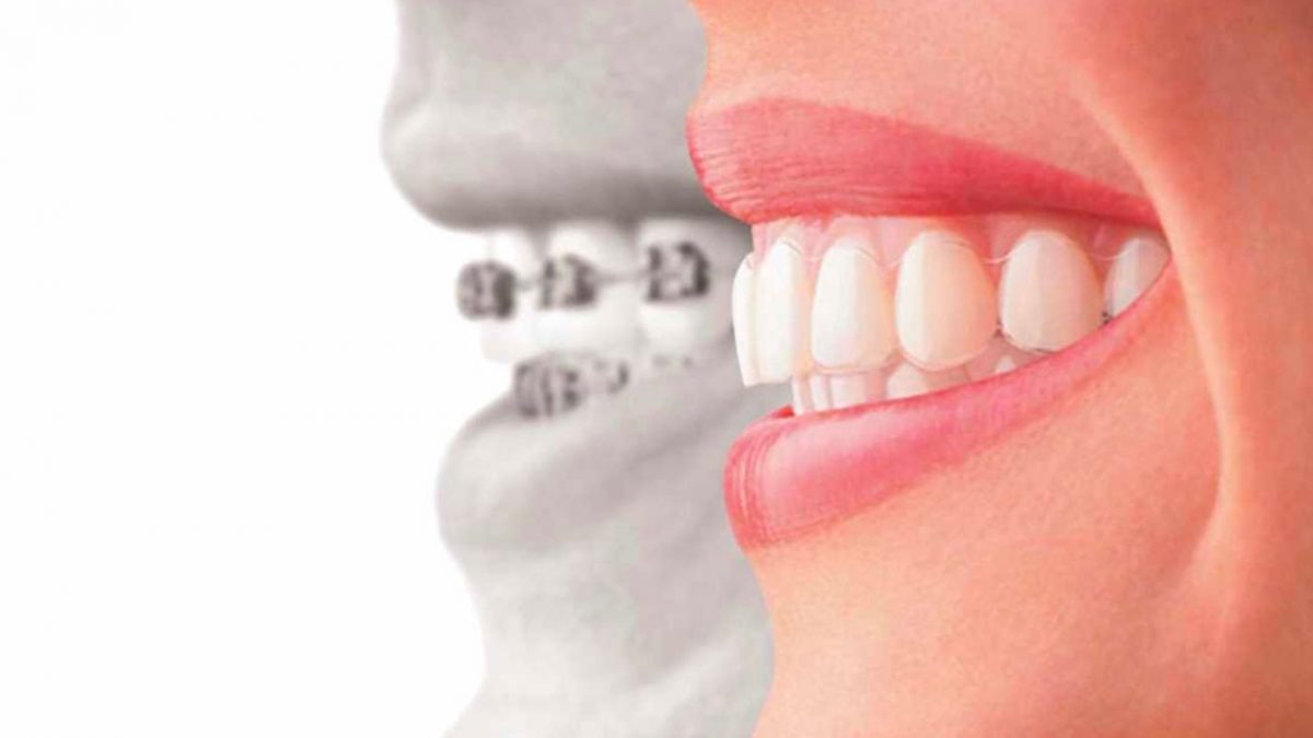 Invisalign VS Aparelhos