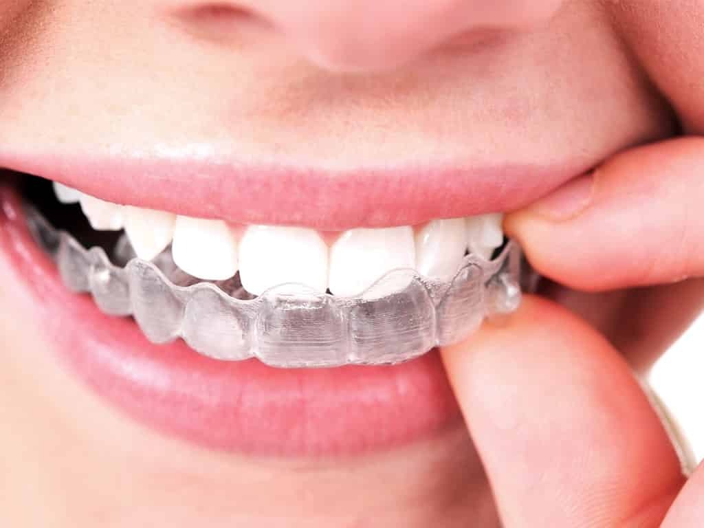 Invisalign VS Aparelhos