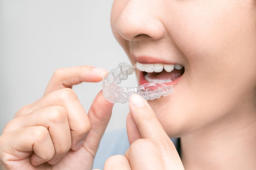 Invisalign VS Aparelhos